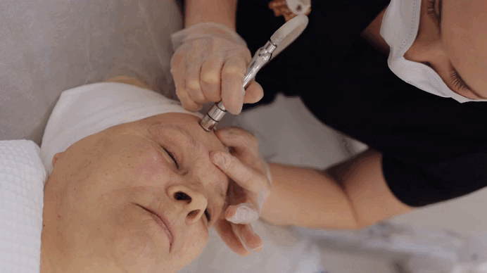 Mikrodermabrasion, mechanisches Peeling an einer Seniorin
