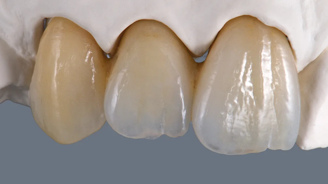 anterior 3 unit bridge  