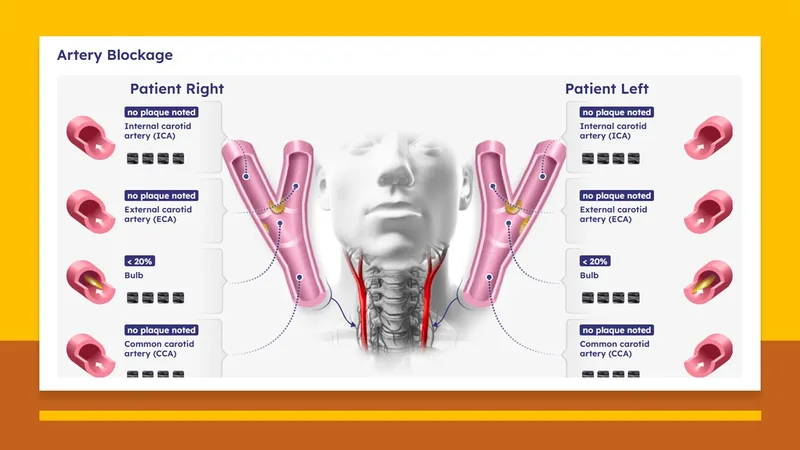 Carotid Ultrasound Exam Results
