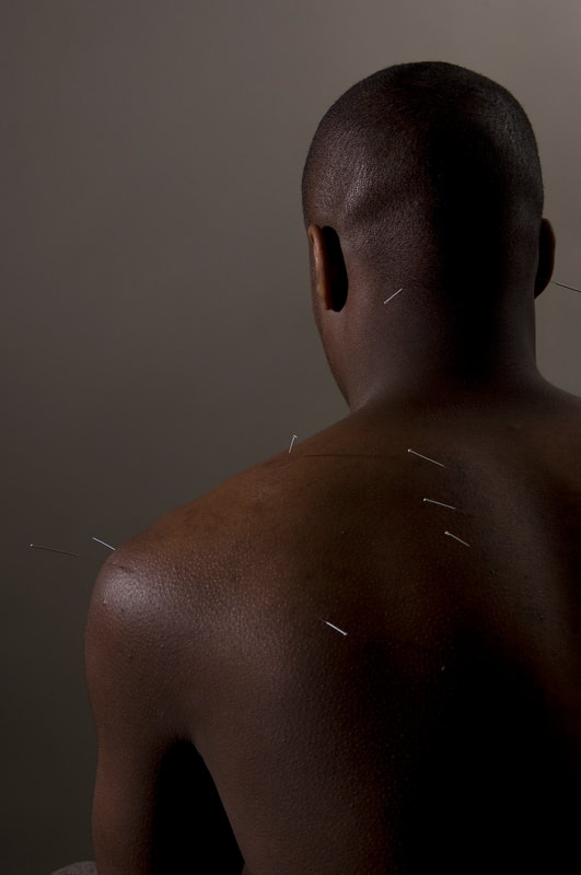 Patient receiving acupuncture on their shoulder/back