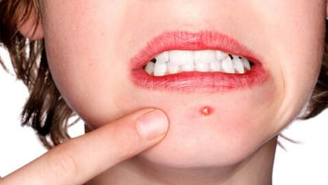 Does popping a zit make it worse or better and how to pop a zit without causing acne scars or infection or making it worse cystic acne tips for oily skin 
