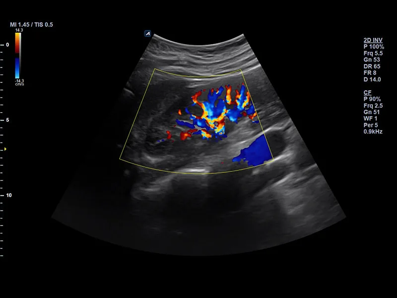註：指使用彩色都卜勒（Color Doppler）技術觀察腎臟血流。