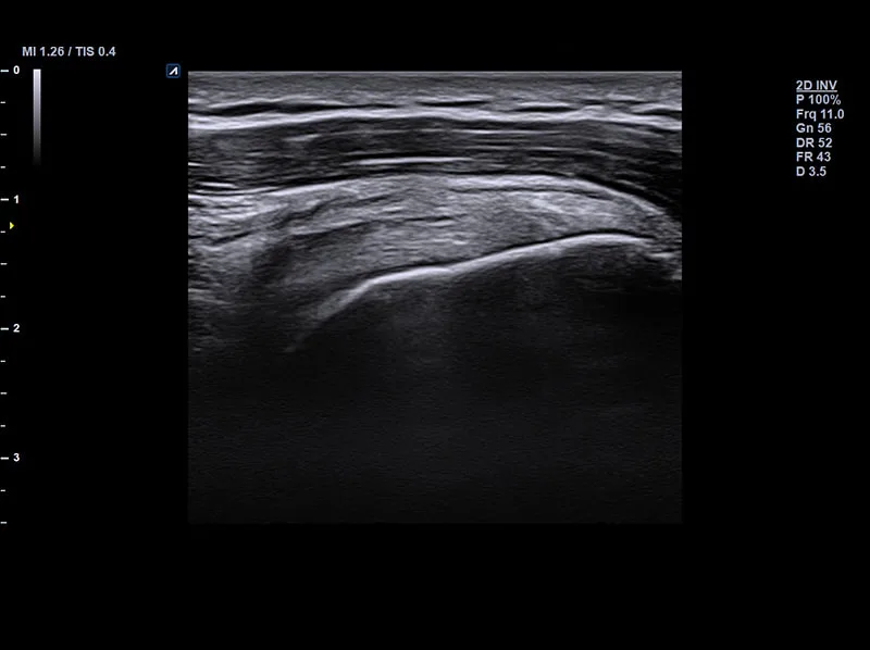 註：棘上肌（Supraspinatus）是肩關節旋轉肌袖（Rotator cuff）的其中一條肌肉，常是檢查重點。