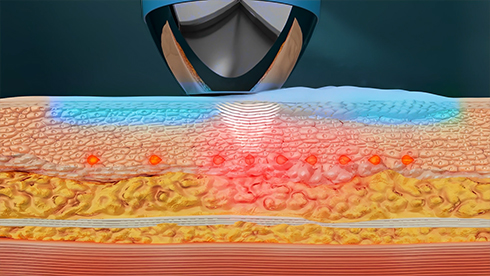 Same Power, Less Pain: Introducing CoolSoniq®