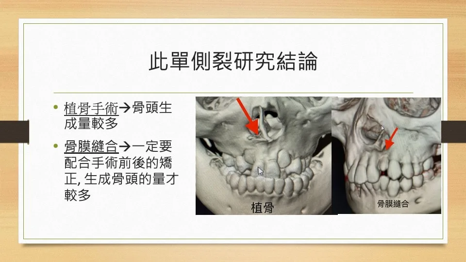 牙床植骨vs骨膜縫合 單側裂研究