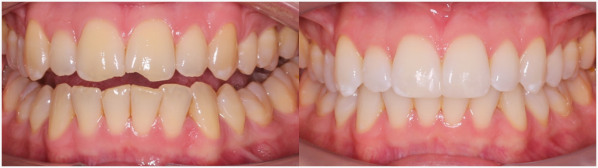 Before and after of composite bonding. 