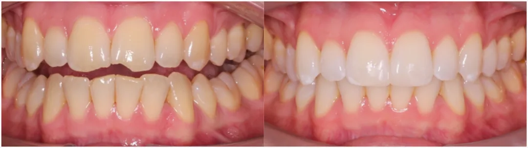 Before and after of composite bonding. 
