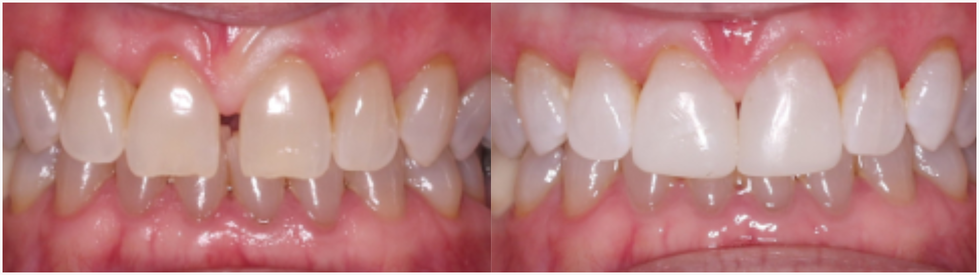 Before and after of composite bonding. 