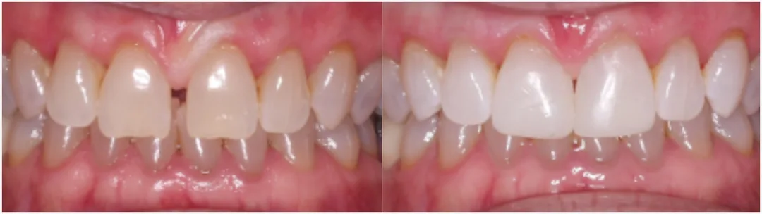 Before and after of composite bonding. 