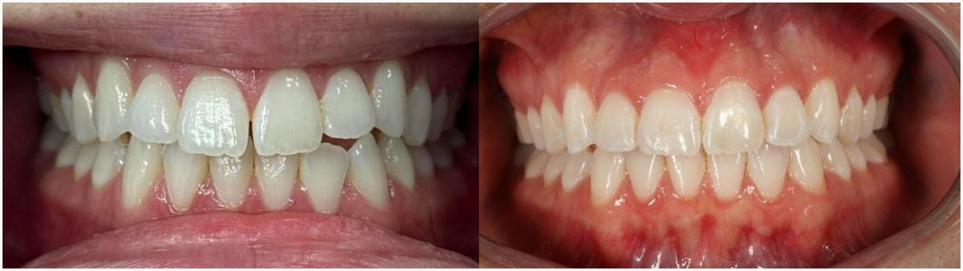 Examples of Invisalign before and after. 