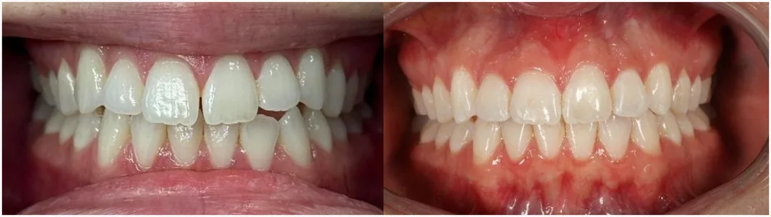 Examples of Invisalign before and after. 