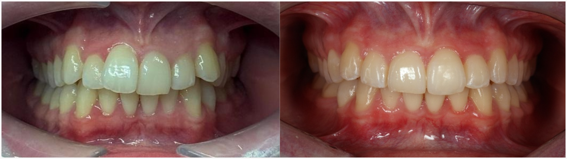 Examples of Invisalign before and after. 