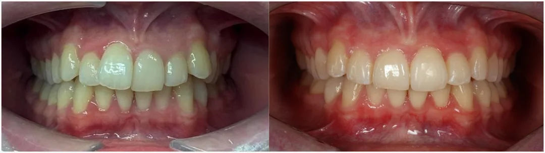 Examples of Invisalign before and after. 