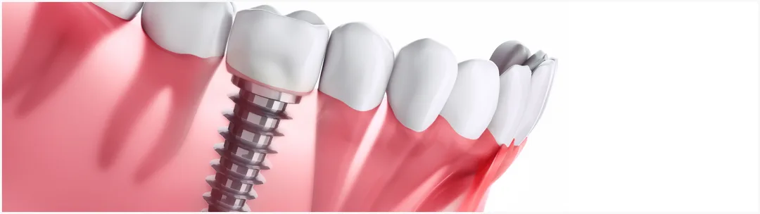 Dental implant diagram. 