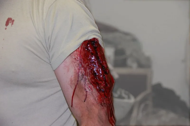 Venous & Arterial Wounds