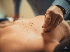 Acupuncture needles placed on humans back