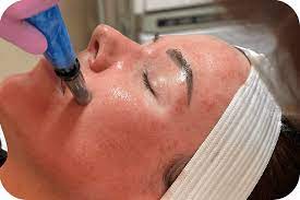 Micro-needling