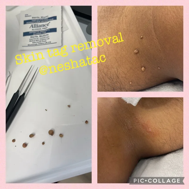 Skin Tag Removal
