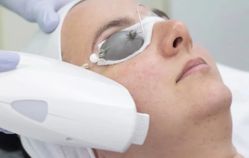 IPL (Photo Facial) Rejuvenation with Vitamin C